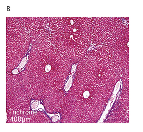 Fig B:  This section from a paraffin-embedded liver sample obtained from mdr2–/– mice on DOT 14 was subjected to H&E and trichrome staining. Components of sclerosing cholangitis score (inflammation, ductal proliferation, necrosis, and fibrosis) were analyzed on a 1-41 scale.
