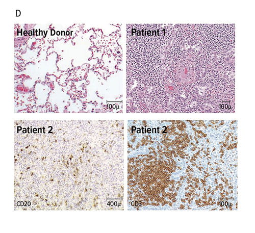 Fig D. Hematoxylin and eosin staining illustrates the contrast between a healthy donor lung and the lung of patient 1. Also shown are immunostains for CD20 (B cells) and CD3 (T cells) in the lung of patient 2.