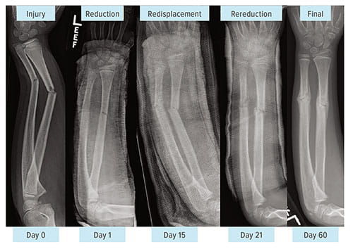 Fig A:  Despite conventional wisdom, these images demonstrate that rereduction of both-bone forearm fractures produces satisfactory outcomes, with apex angulations less than 5 degrees. Rereduction also costs less than surgery.