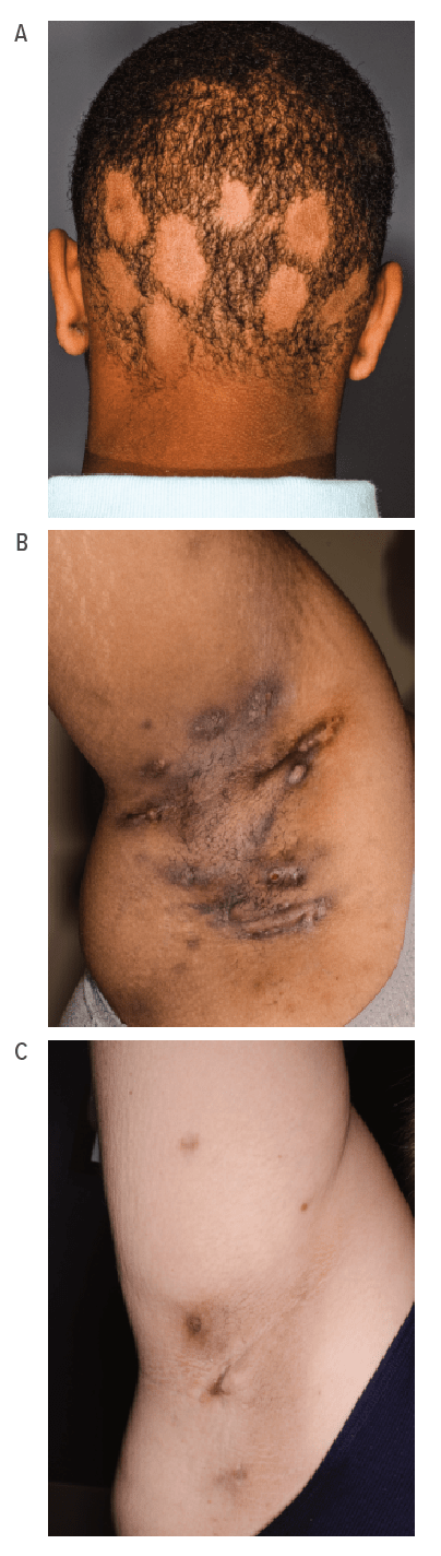 Fig A: Some off-label uses of biologic response modifiers show promise for treating children with dermatologic conditions, including: omalizumab for atopic dermatitis (A); etanercept and other TNF-a antagonists for pyoderma gangrenosum (B); and rituximab for autoimmune bullous diseases (C).