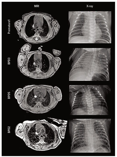 Fig A:  Researchers used MRI to compare the axial fast gradiant echo slice of four premature babies, three with bronchopulmonary dysplasia (BPD) and one without. The MRIs more clearly indicate that Patient BPD5 shows signs of fibrotic opacities. In Patients BPD2 and BPD3, these features and multiple regions of emphysema and hyperexpansion are described in the X-rays.