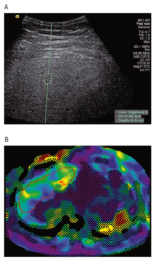 Fig A+B:  These ultrasound (A) and MR elastography (B) images of the liver are from a study patient with a BMI of 35.7 kg/m2. The green box in the ultrasound image is where the liver stiffness measurement is being made. The color coding in the MRI image reflects areas of the liver that have different measured stiffness values.