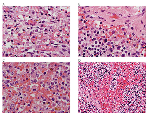 Fig A:  These microscope images show examples of hemophagocytosis characterized by macrophages with engulfed red blood cells in lymph node (A, B) and spleen (C, D) in fatal cases of H1N1 influenza.