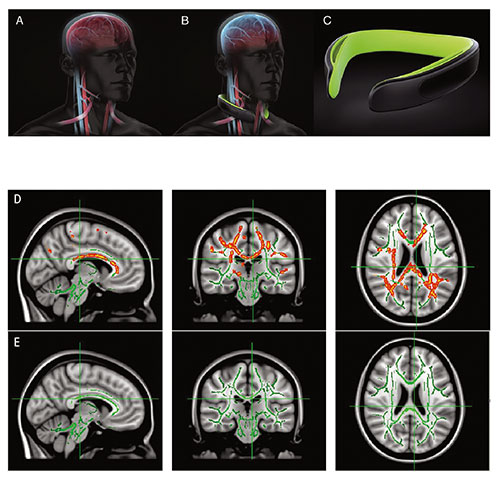 Fig A:  Diffusion tensor imaging shows how sports collisions can affect the brain’s white matter. A: Illustrates normal blood flow. B: Illustrates blood volume changes with Q-Collar. C: The Q-Collar. D: Marked areas show increases in mean diffusivity. E: Marked areas in this row show increases in radial diffusivity.