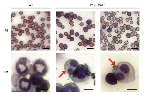 These images show peripheral blood (PB) smears and bone marrow (BM) cytospins from wild type mice (WT) and mice overexpressing TRAF6. Arrows indicate dysplastic myeloid cells with Pseudo-Pelger Hüet anomaly.