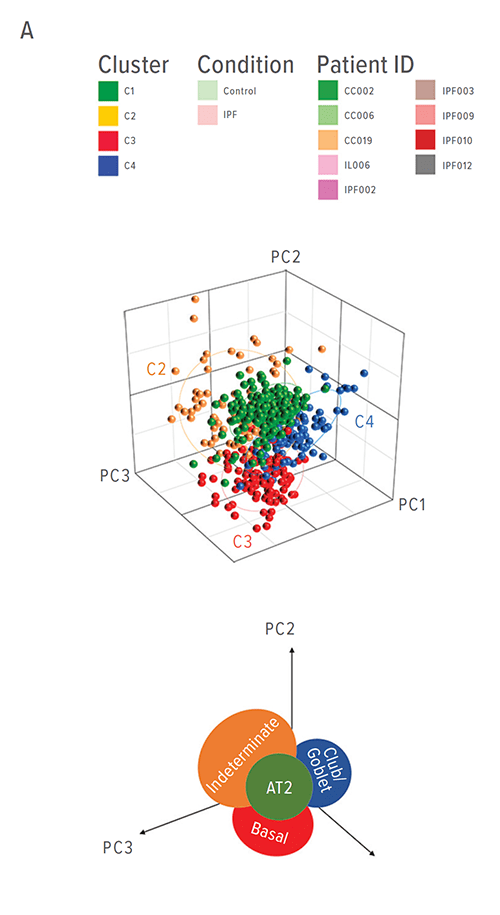 These figures depict single-cell RNA sequencing analysis from human IPF and normal lung epithelial cells. A: Hierarchical clustering and principal component analysis of 540 single cells from control (n = 3) and IPF patients (n = 6) reveals four major cell types, termed as normal AT2 (C1, green), indeterminate (C2, yellow), basal (C3, red), and club/goblet (C4, blue) cells.