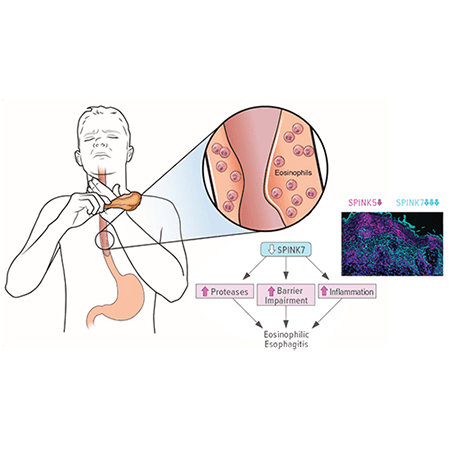 An image depicting and EoE patient with food dysphagia.
