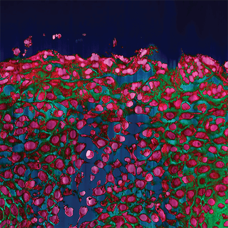 An image of epithelium with eosinophilic esophagitis.