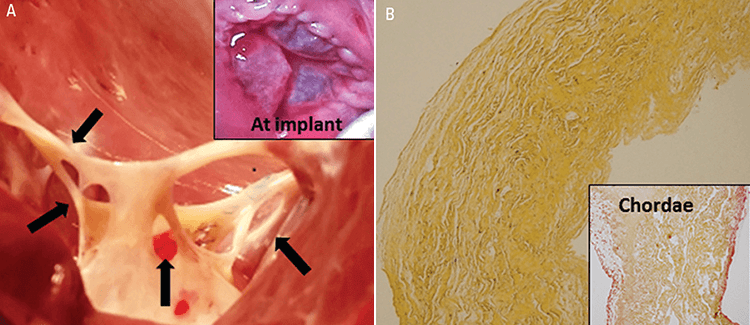 An image depicting an explanted SIS-ECM tricuspid valve at 18 months.