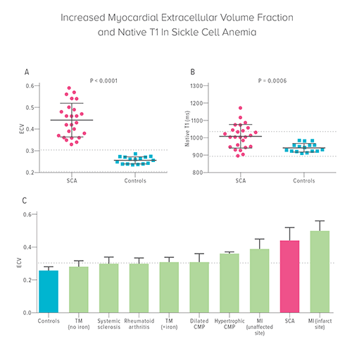 An image showing increased myocardial extracellular volume fraction and Native T1 in sickle cell anemia.
