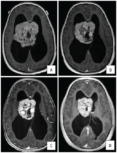 MRI images depicting the shrinkage of a large SEGA tumor over time.