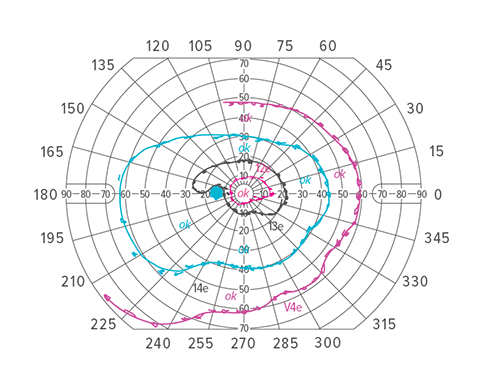 An image of the Goldmann visual field results for patient.