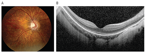 An image for Ophthalmology's Featured Research.