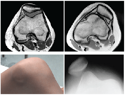 An image showing normal patellofemoral articulation and patellar dislocation.