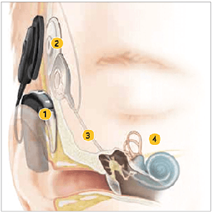 An image showing how a cochlear implant works.