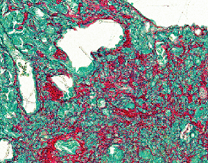 An image depicting a mouse lung with idiopathic pulmonary fibrosis (IPF).