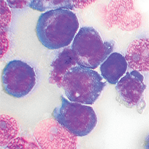 An image showing leukemia cells.