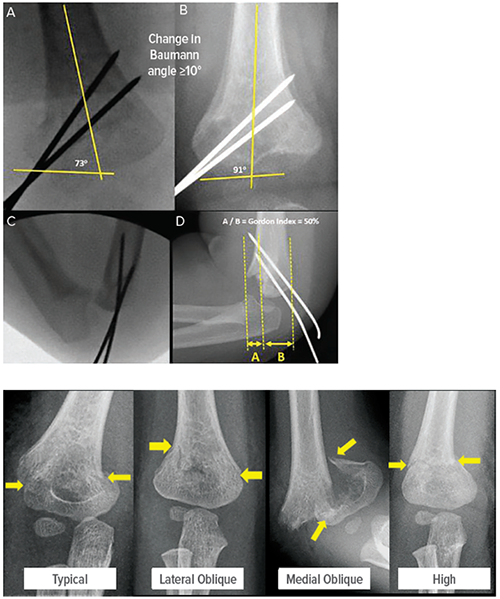 Images demonstrating supracondylar humeral fracture patterns.