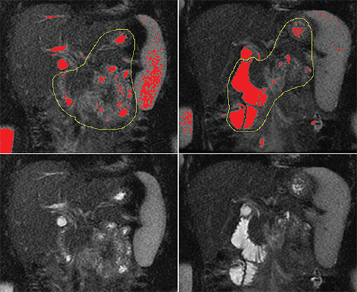 Pre-secretin coronal images of the abdomen and post-secretin images.