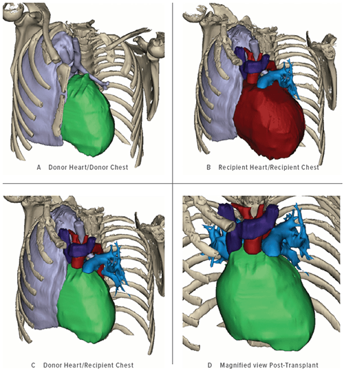 An image showing a 3-D reconstruction of a heart and chest cavity.