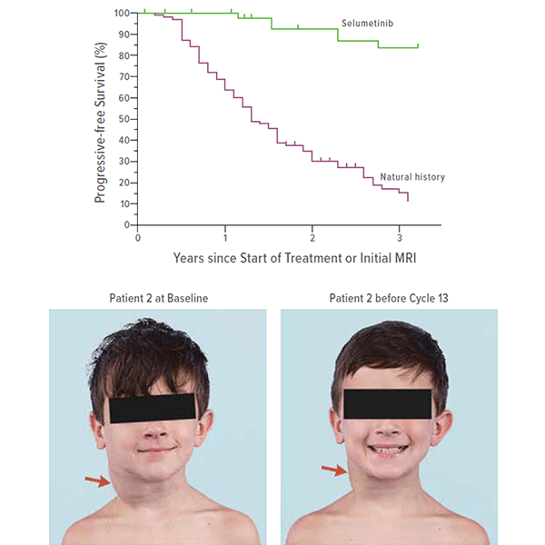 An image showing tumor size reduction achieved after selumetinib treatment.