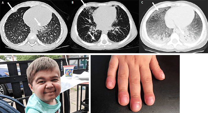 Images of a patient with systemic JIA-associated lung disease.