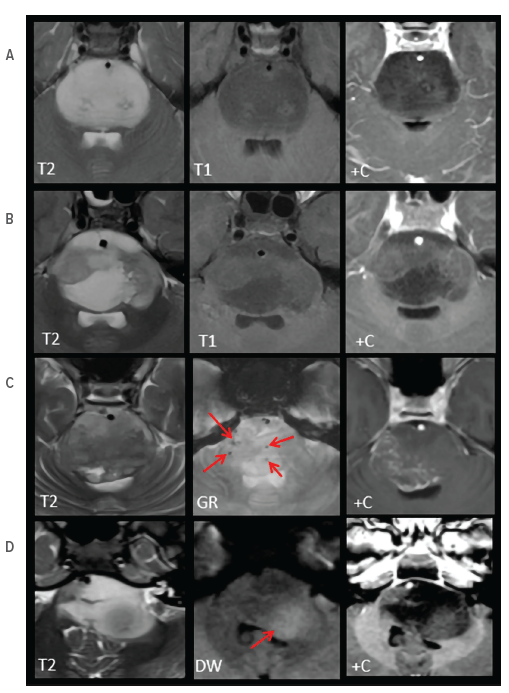 An image of examples of submitted cases classified as characteristic of DIPG.