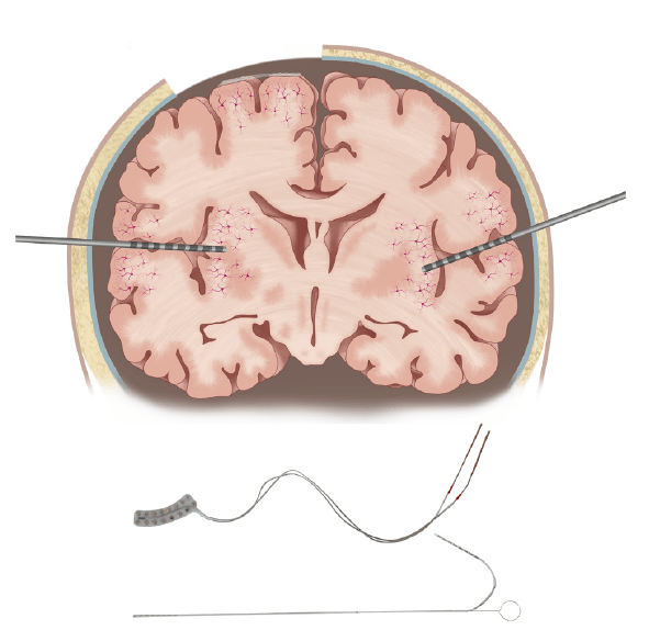 An illustration of a brain and sensor methods.