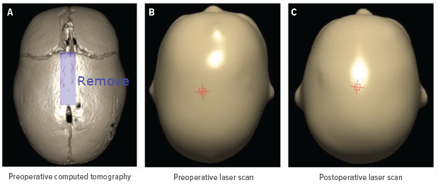 An image of scans related to craniosynostosis research.