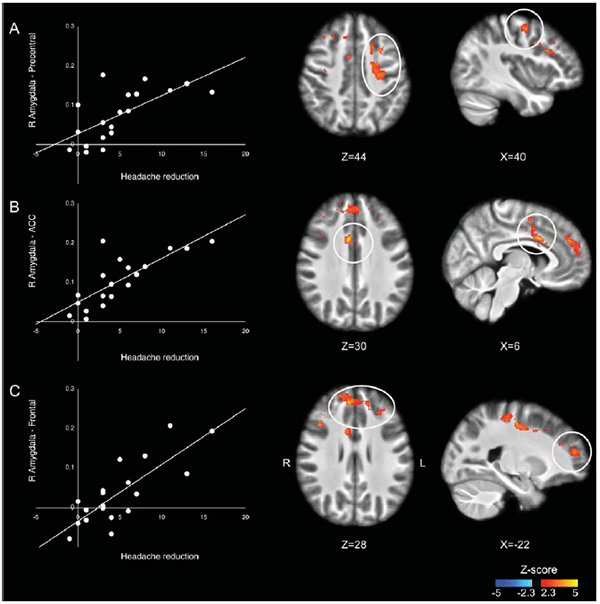 An image showing amygdalar connectivity relates to reduced headache frequency after cognitive behavioral therapy.