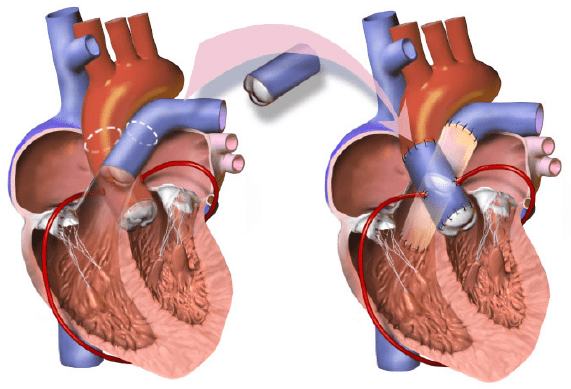 An illustration depicting the basic steps of the Ross Procedure to correct for aortic valve defects.