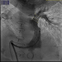 Image from a cardiac catheterization showing  a heart stent made specifically for infants and young children.