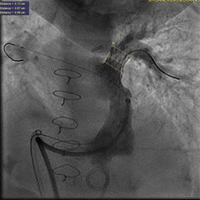 Image from a cardiac catheterization showing  a heart stent made specifically for infants and young children.