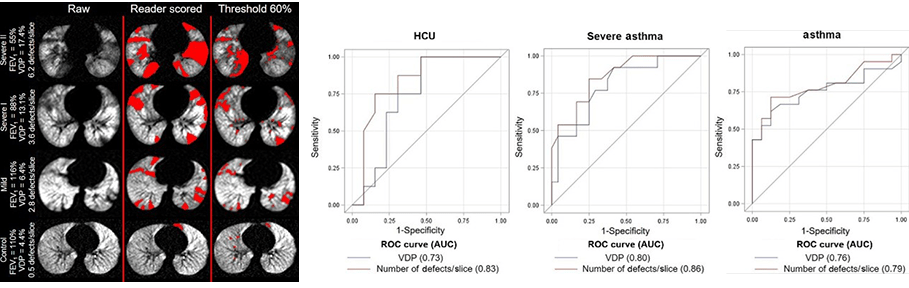 A photo of imaging research on asthma.