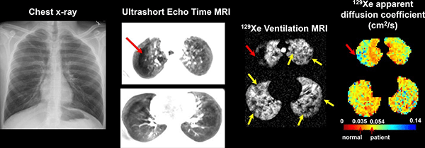 An image of a patient's chest X-ray.