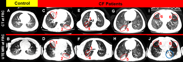A photo of CT and UTE MRI images of cystic fibrosis patients.