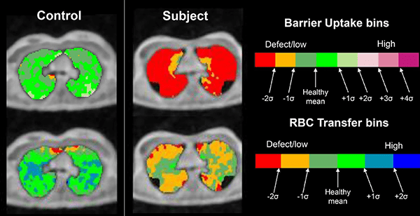 An image of axial 129Xe MRI gas-exchange maps.