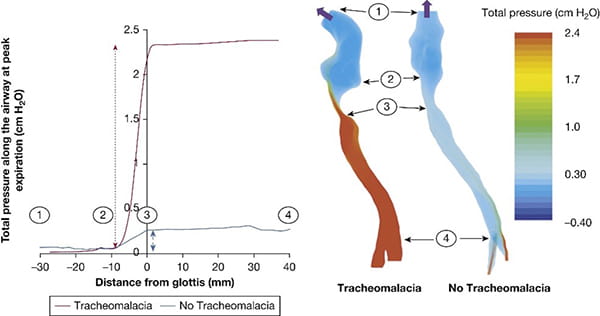A photo of imaging research on tracheomalacia.