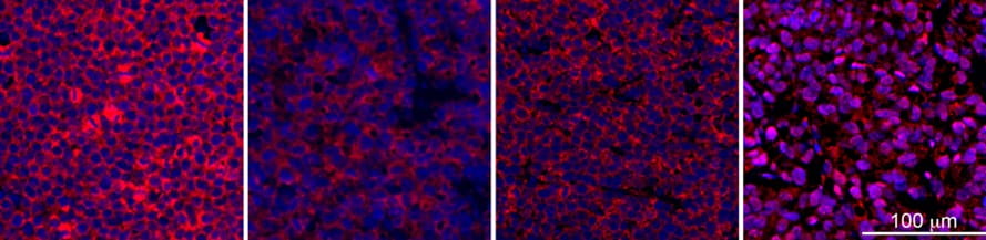 cancer biology biomarker treatment