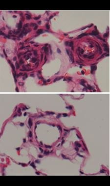 pulmonary arterial hypertension