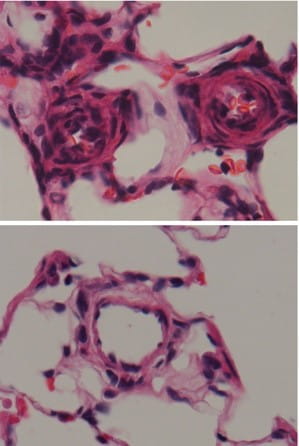 pulmonary arterial hypertension