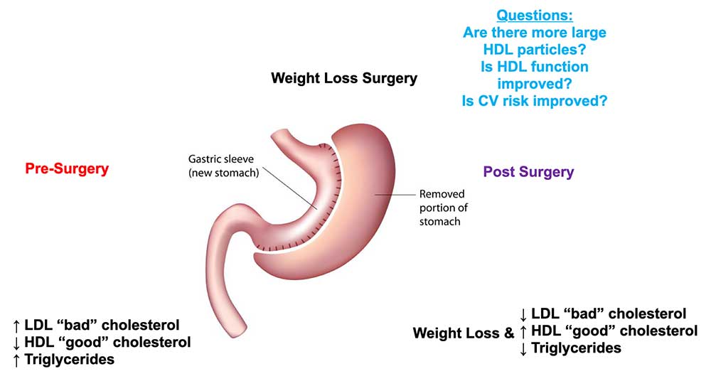 Weight loss surgery and the effects on HDL subspecies composition and function.