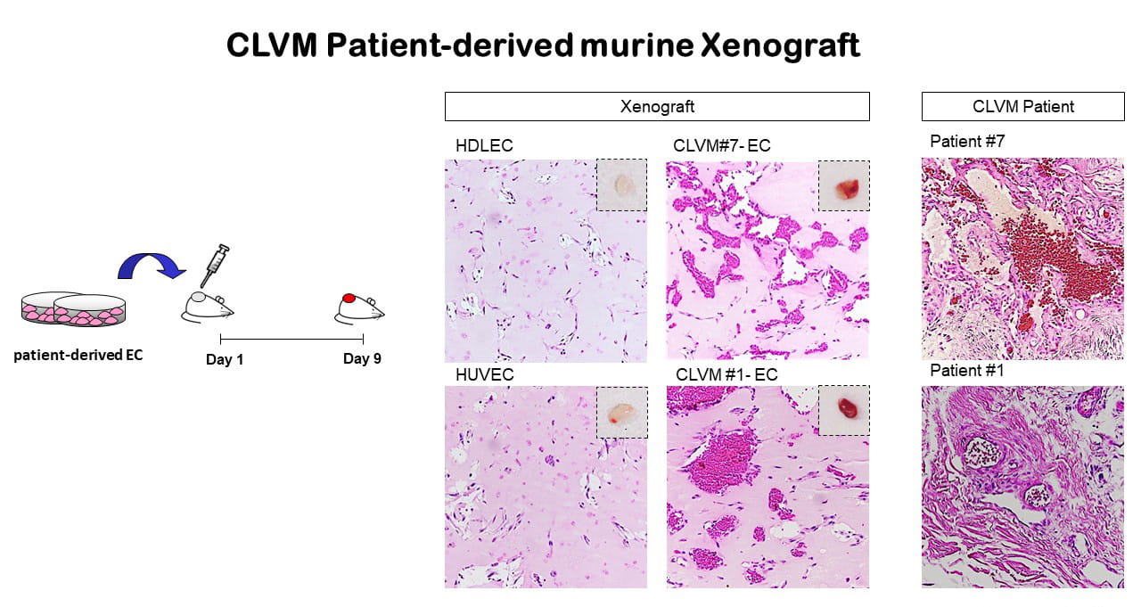 CLVM Patient-derived murine Xenograft.
