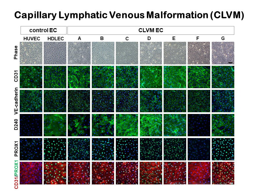 Capillary Lymphatic Venous Malformation (CLVM).