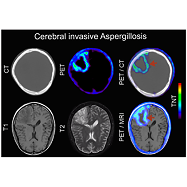 F-FDS in human cerebral invasive Aspergillosis.