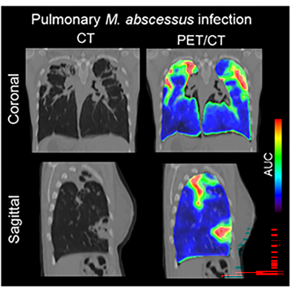C-PABA in human pulmonary M. abscessus infection