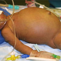 Necrotizing entercolitis.