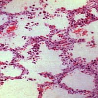 Bronchopulmonary dysplasia.