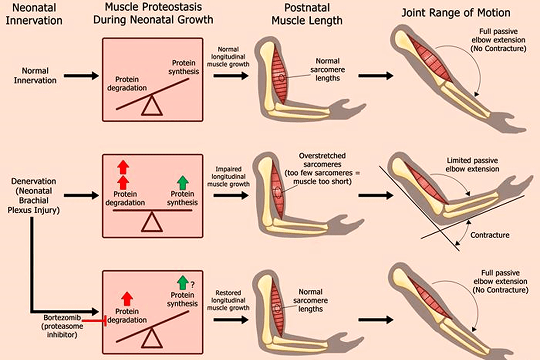 Illustrations for neonatal brachial plexus palsy research.