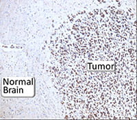 Immunohistochemical staining showing high expression of active AMP kinase in a brain tumor.